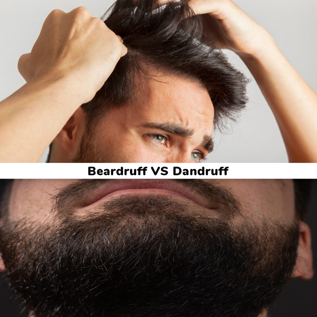 Flakes on beard and scalp comparison
