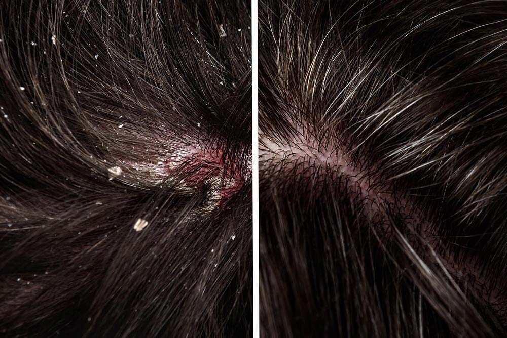 Close-up scalp showing severe dandruff before and after treatment