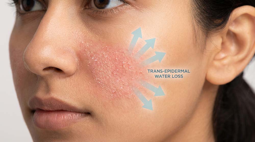 compromised skin barrier showing visible trans epidermal water loss